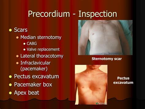 precordium heave or lift.